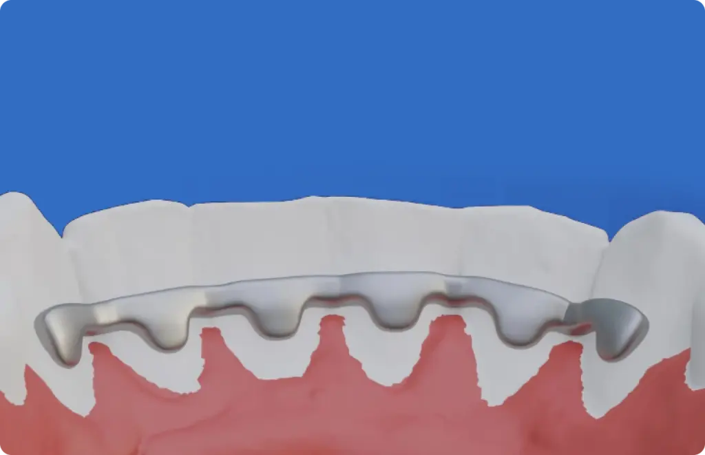 PEEK (Polyetheretherketone)