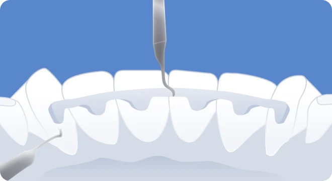 La contention en orthodontie sur mesure eZtain