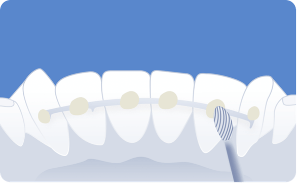 enlèvement des excès de collage suite au collage d'une contention eZtain version simple