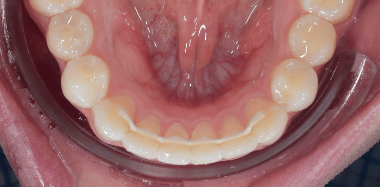 The most aesthetic, durable, and comfortable orthodontic retainer, designed for a lasting smile.