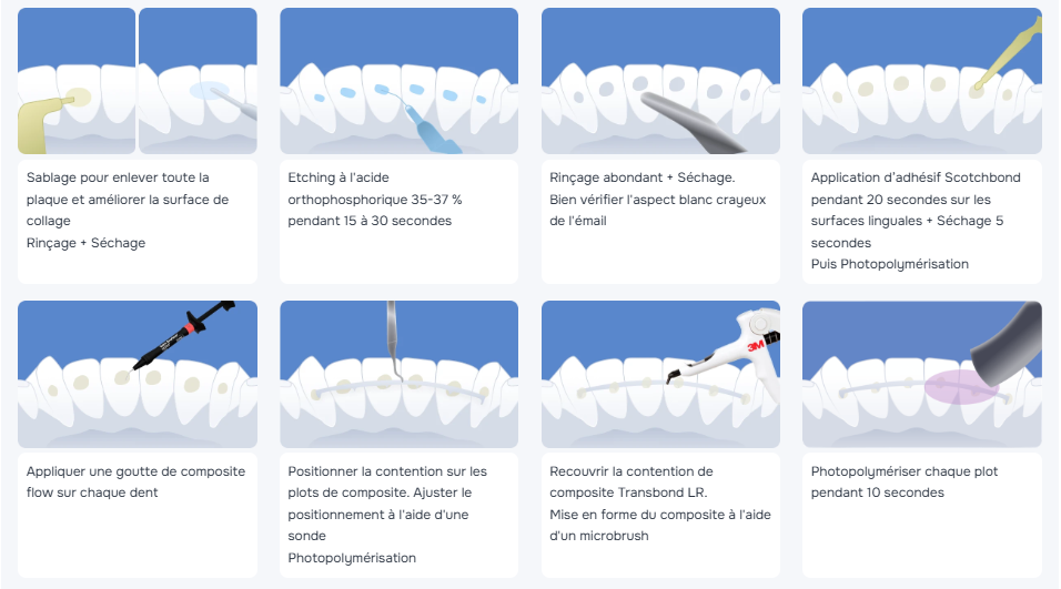 Pose d’un fil de contention dentaire : procédure et conseils
