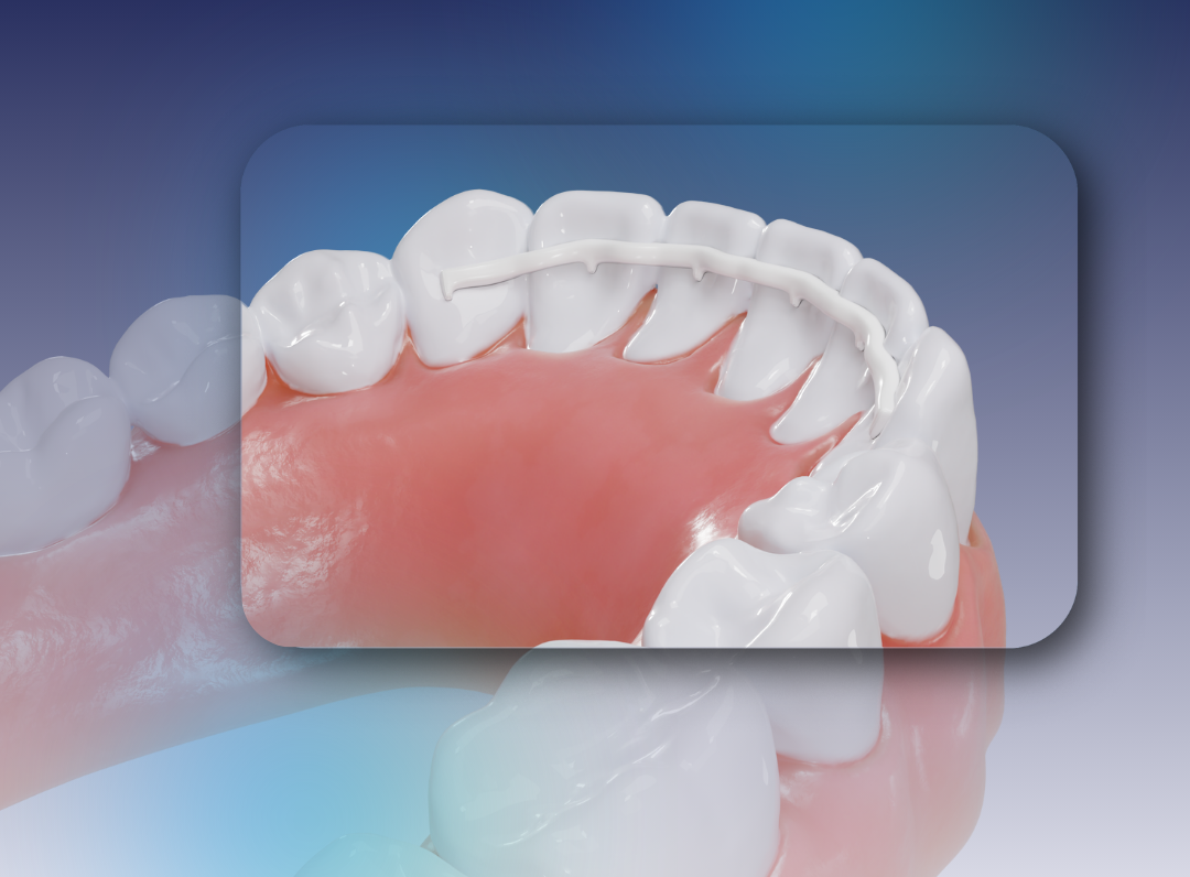 Contention d'orthodontie eztain