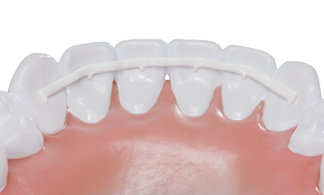 Contention dentaire blanche