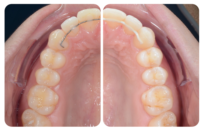 The 100% Custom-Made PEEK Retainer