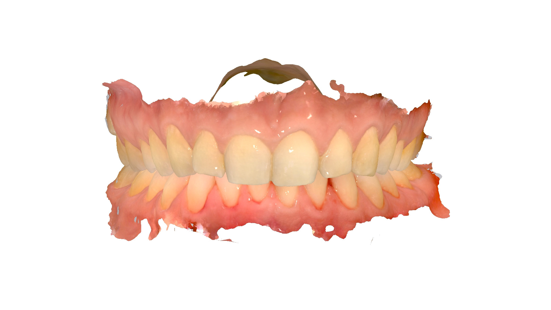 Vue frontale des dents avant traitement par aligneurs invisibles - analyse orthodontique