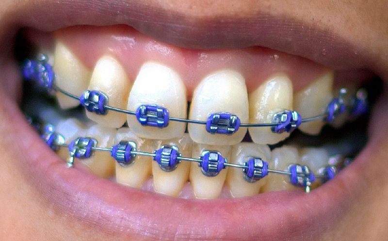 Bagues dentaires métalliques pour rapprocher les dents