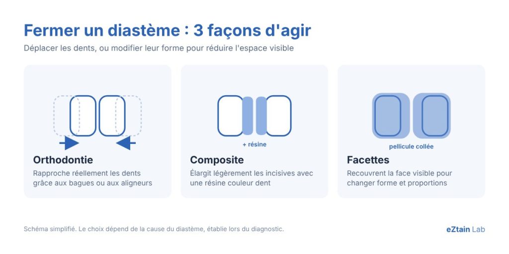 Schéma : fermer un diastème par orthodontie, composite ou facettes