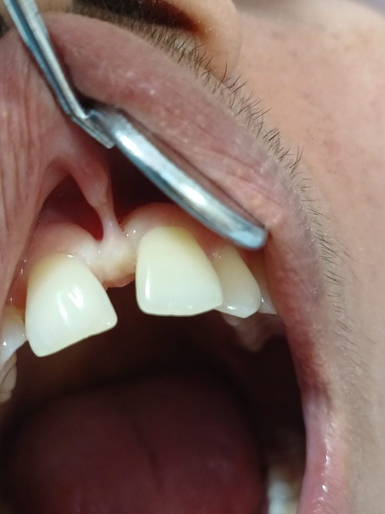 Frein labial inséré bas entre les incisives, une cause possible de diastème